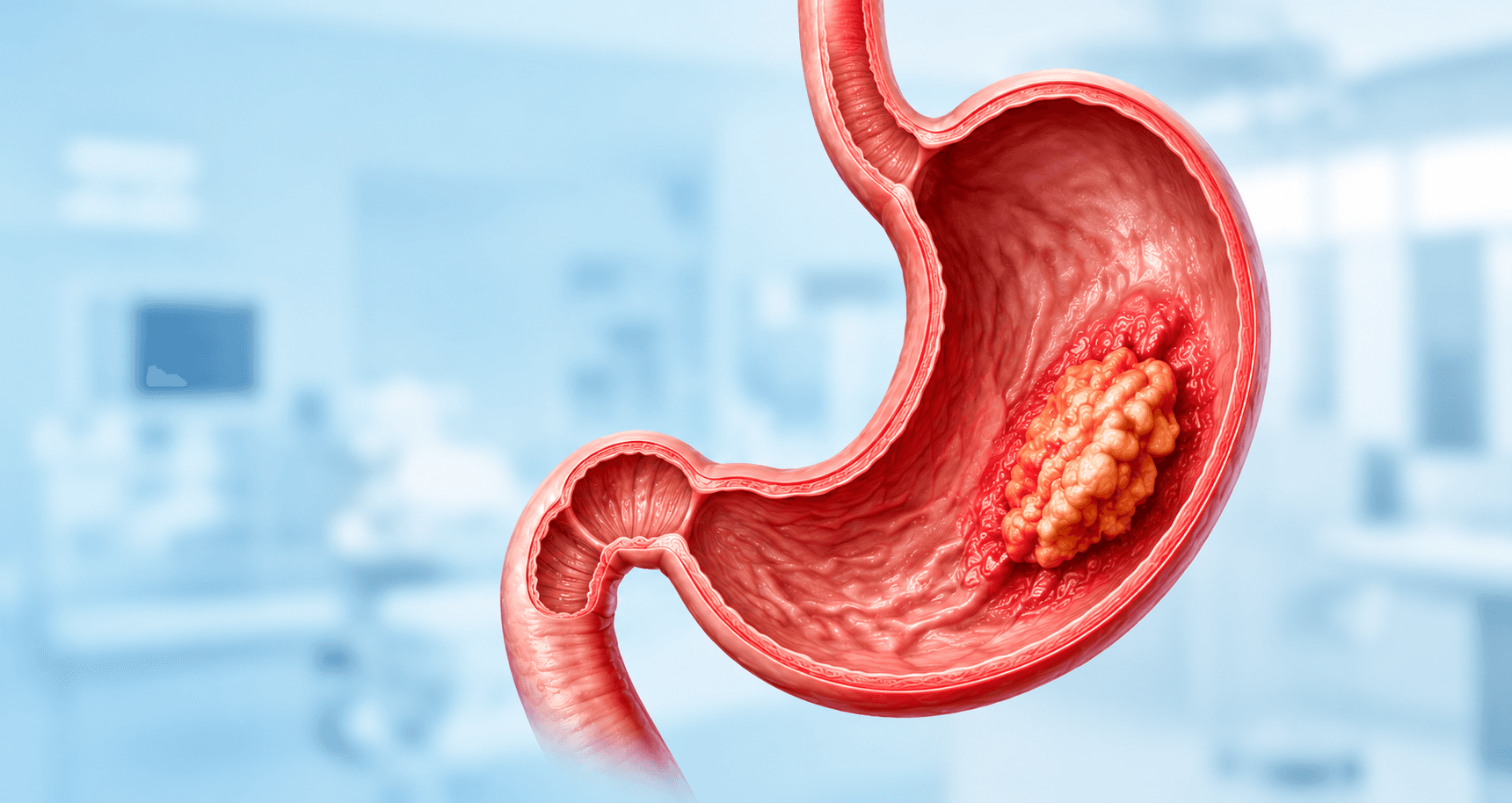 Is Your Abdominal Pain a Sign of Gastric Cancer?