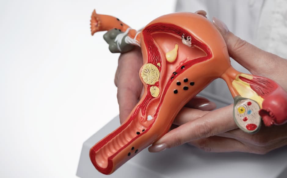 What Are the Signs of Endometrial Cancer? Early Symptoms You Shouldn't Ignore
