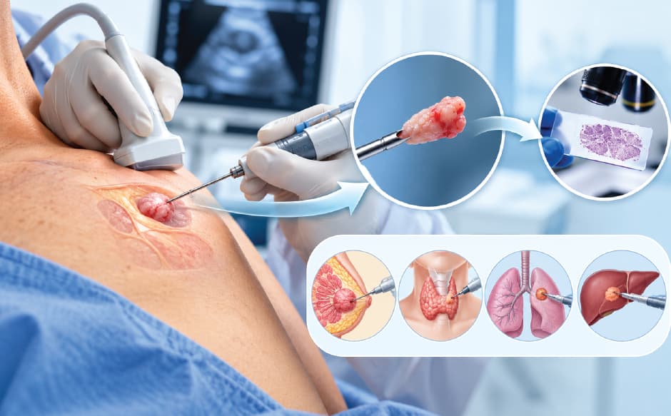 What Is a Needle Biopsy? Types, Uses, and How it Works