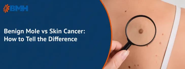 Benign Mole vs Skin Cancer